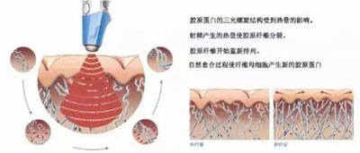 減肥/抗衰兩不誤，BTL溶脂刀儀器一次滿足你