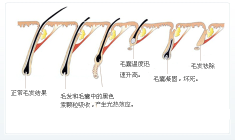 脫毛為什么一次性脫不干凈？原因在這里