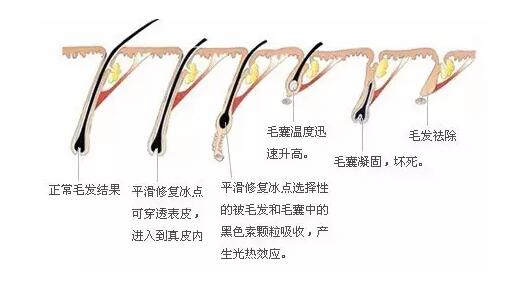 為何OPT脫毛儀能在美容儀器中獨(dú)占鰲頭？