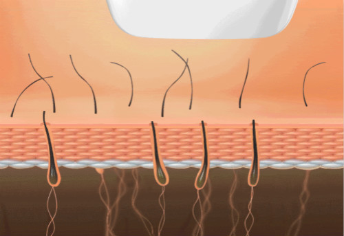 在美容院使用OPT脫毛儀無痛脫毛時(shí)需要注意些什么？