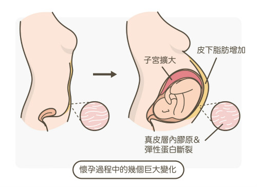 一文秒懂！妊娠紋肥胖紋保養(yǎng)、治療及預(yù)防全攻略