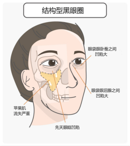 區(qū)分黑眼圈！黑眼圈的成因、分類、預(yù)防與治療全攻略