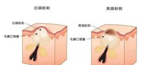 美容儀器廠家教您如何快速祛除黑頭？