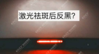 激光祛斑之后皮膚會反黑？美容儀器廠家教你這樣預防