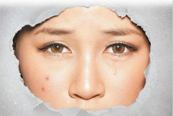 拒當(dāng)「痘花妹」！看痘痘生長(zhǎng)的位置判斷也許是身體出了問(wèn)題