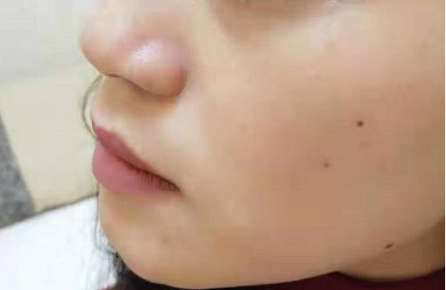 小氣泡美容儀器到底值不值的做呢！