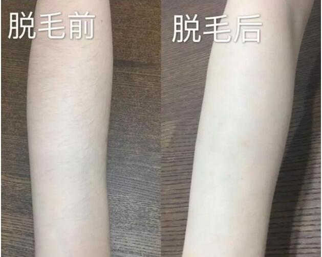 激光脫毛器哪個(gè)牌子好_脫毛儀廠家