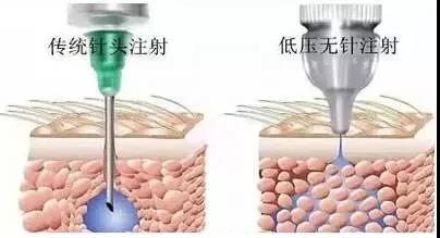 水光針和無針?biāo)獾降啄膫€(gè)效果好？